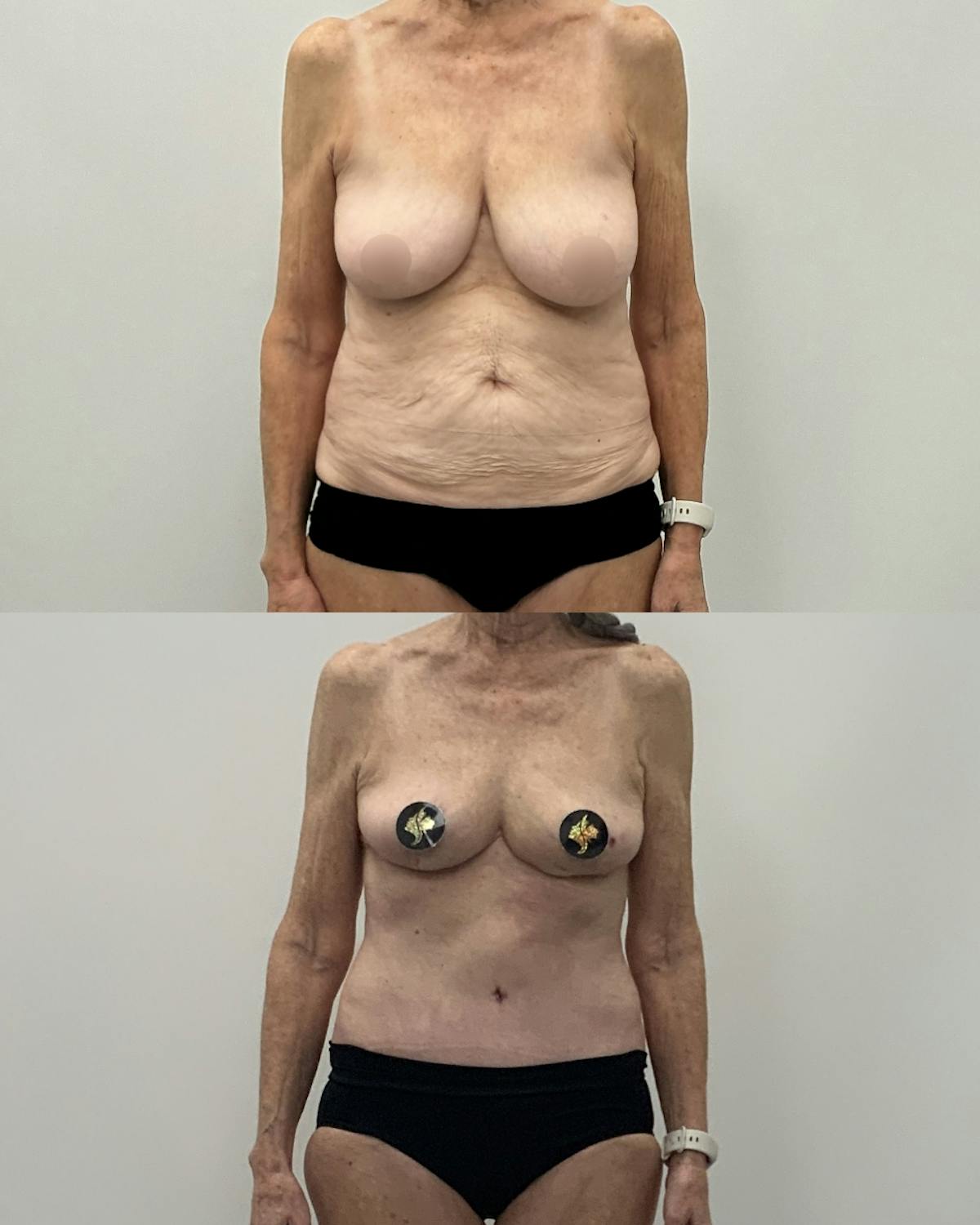 Mommy Makeover Before & After Gallery - Patient 297587 - Image 1