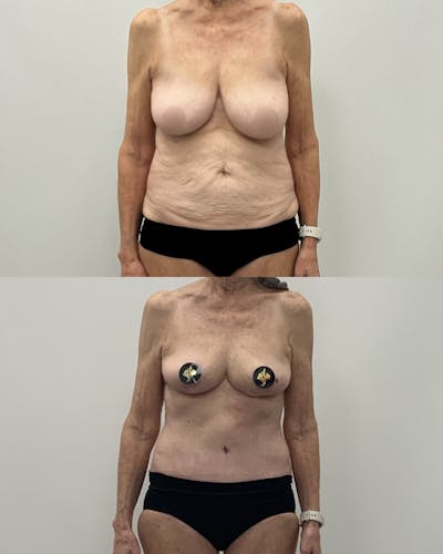 Mommy Makeover Before & After Gallery - Patient 297587 - Image 1