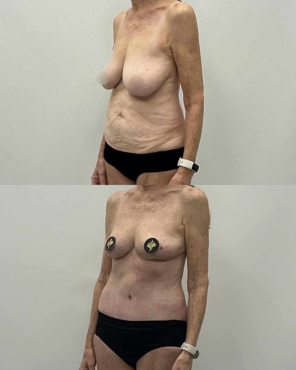 Mommy Makeover Before & After Gallery - Patient 297587 - Image 2
