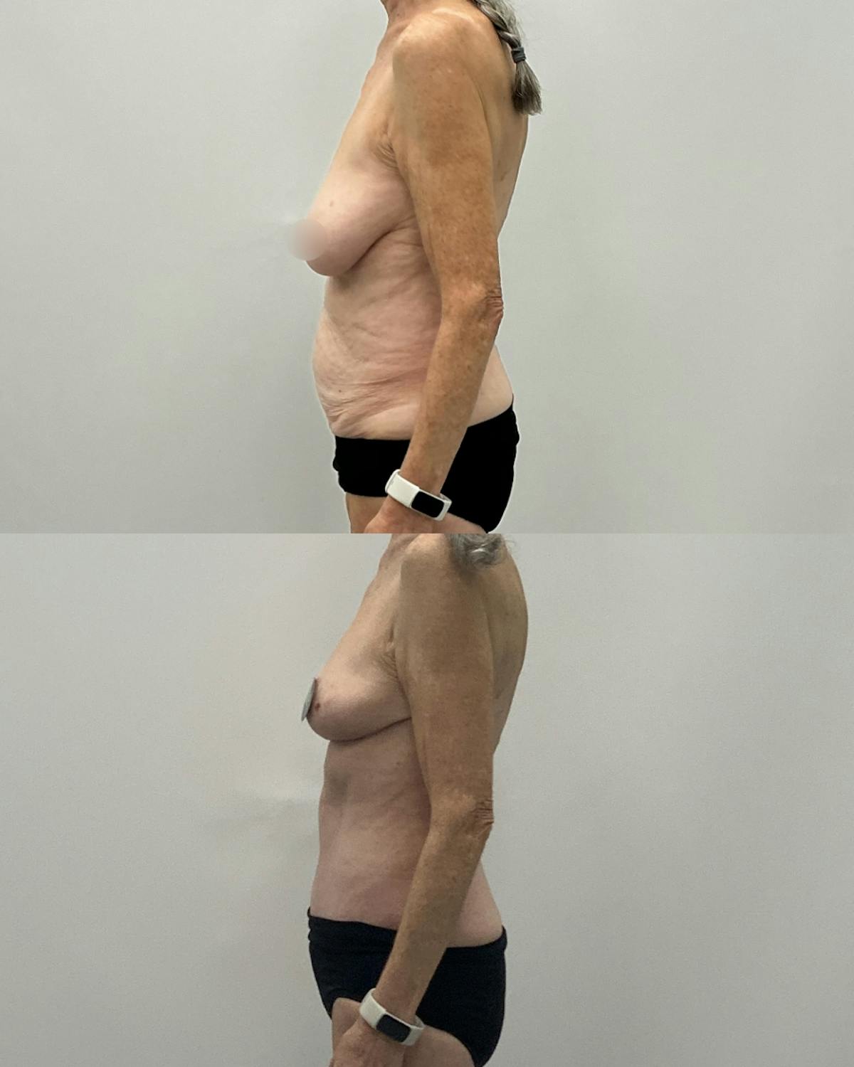 Mommy Makeover Before & After Gallery - Patient 297587 - Image 3