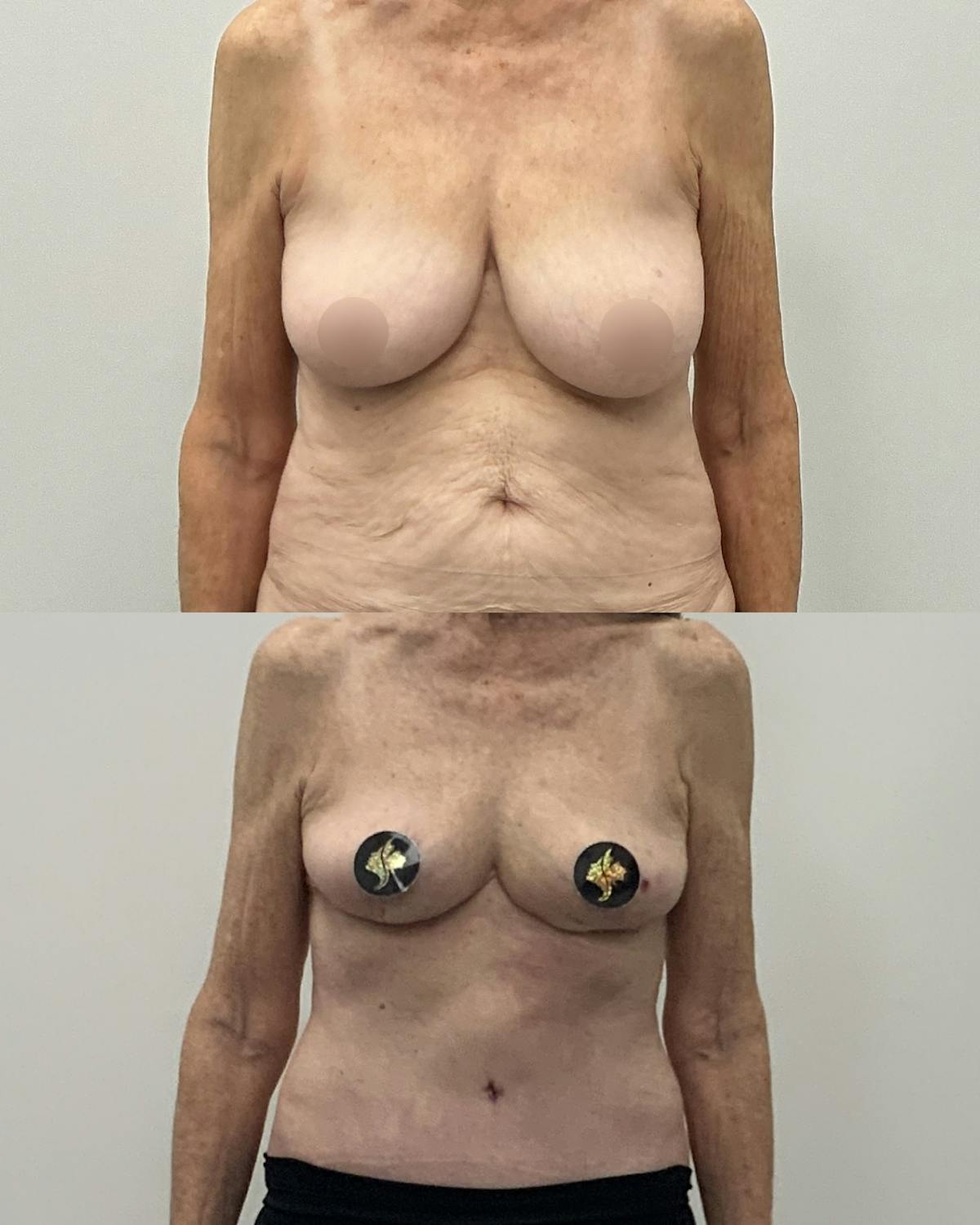 Breast Lift Before & After Gallery - Patient 137965 - Image 1
