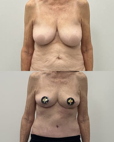 Breast Lift Before & After Gallery - Patient 137965 - Image 1