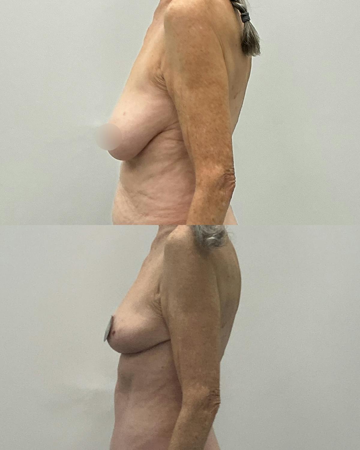 Breast Lift Before & After Gallery - Patient 137965 - Image 3