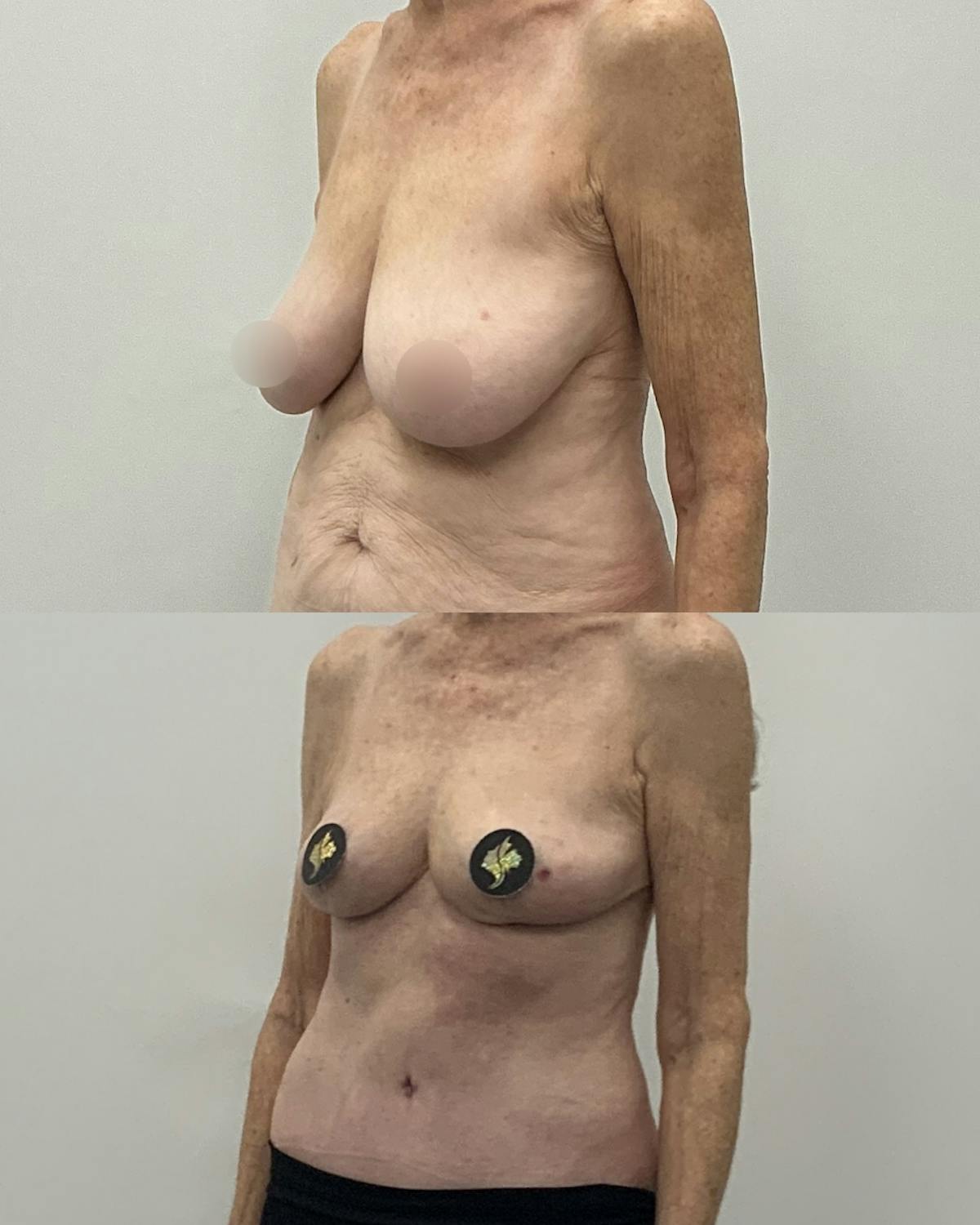 Breast Lift Before & After Gallery - Patient 137965 - Image 2