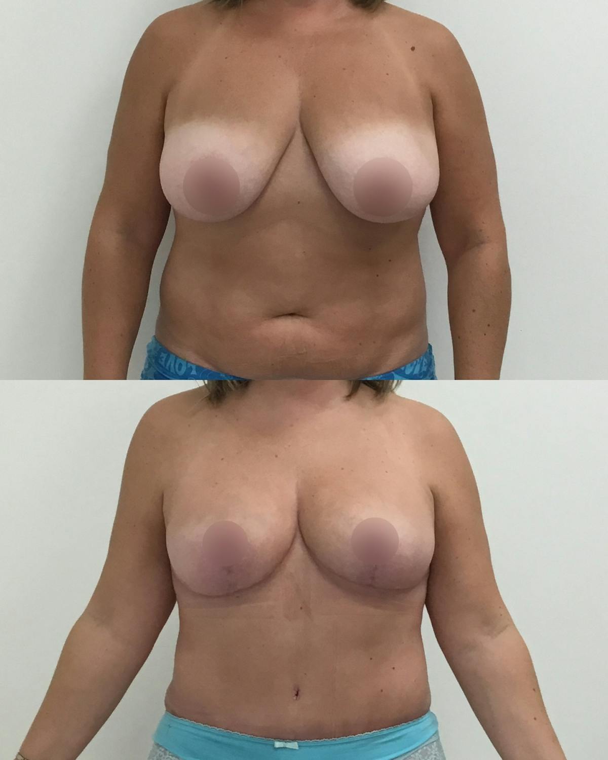 Breast Reduction Before & After Gallery - Patient 354567 - Image 1