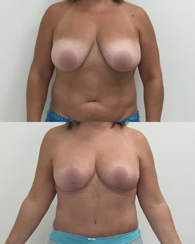 Breast Lift Before & After Gallery - Patient 803682 - Image 1