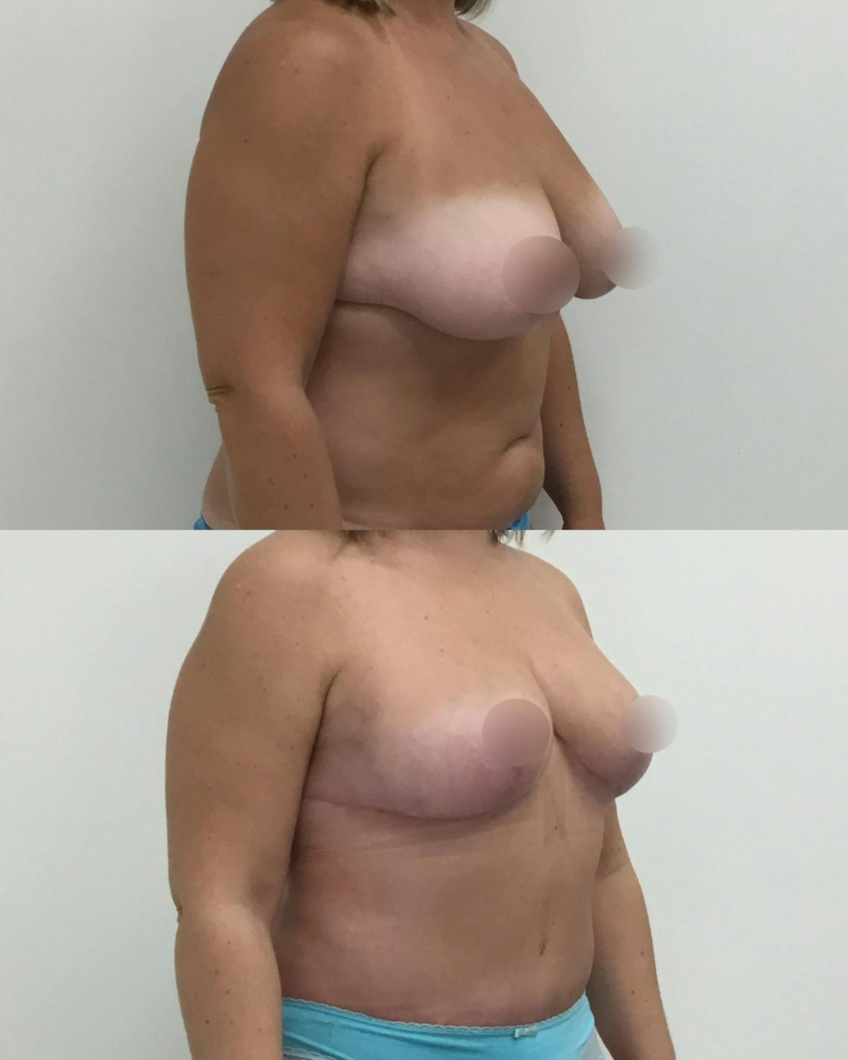 Breast Reduction Before & After Gallery - Patient 354567 - Image 2
