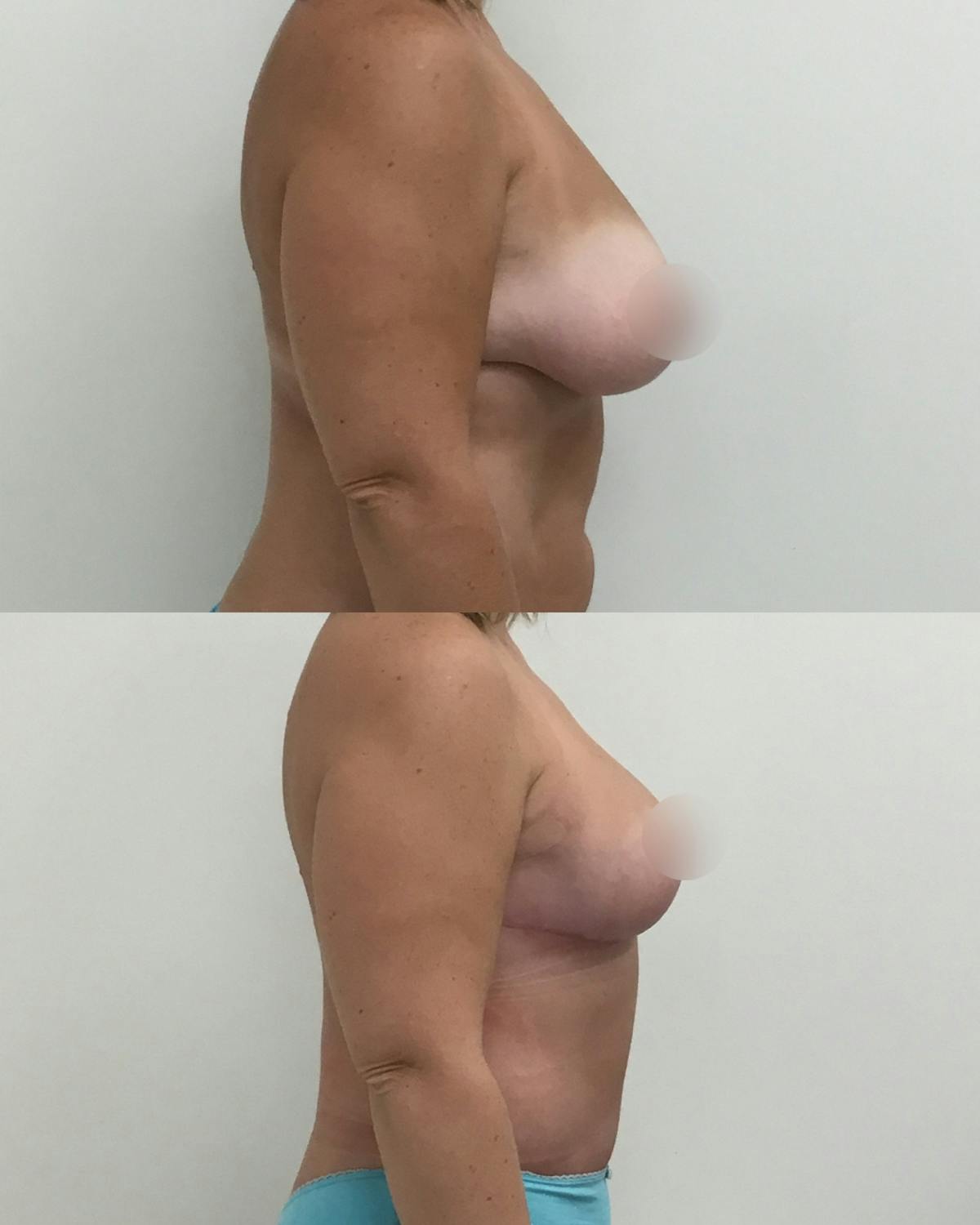 Breast Reduction Before & After Gallery - Patient 354567 - Image 3