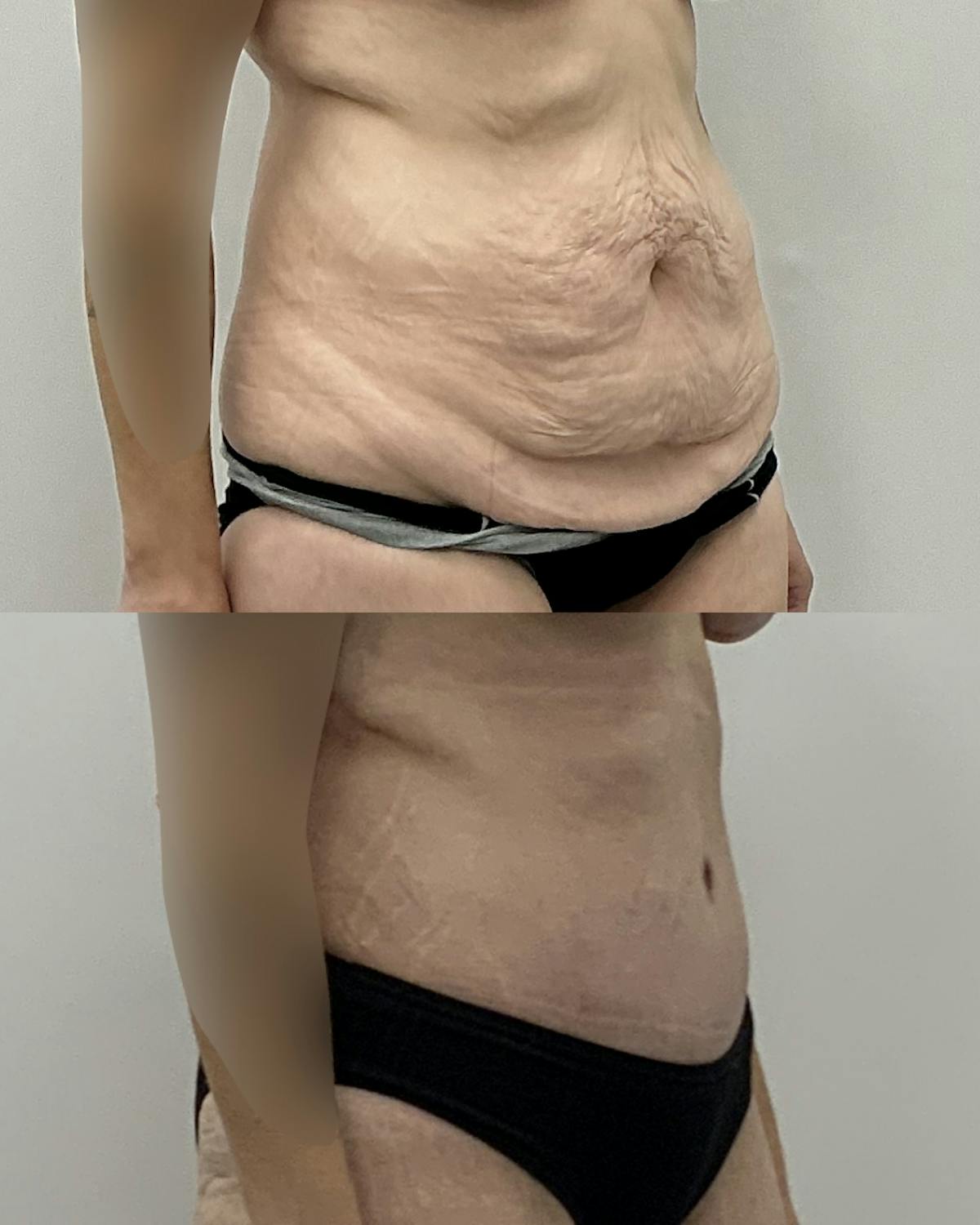 Tummy Tuck Before & After Gallery - Patient 371611 - Image 2