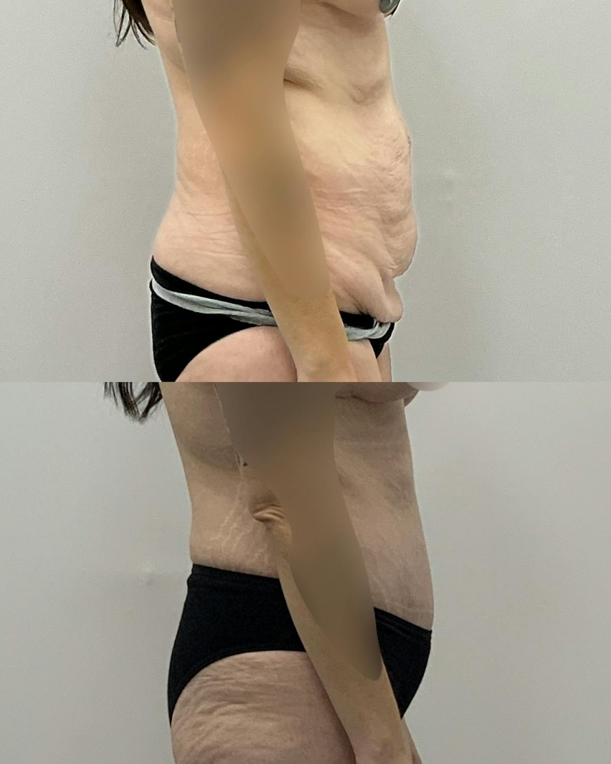 Tummy Tuck Before & After Gallery - Patient 371611 - Image 3