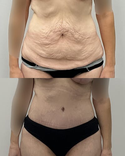 Tummy Tuck Before & After Gallery - Patient 371611 - Image 1