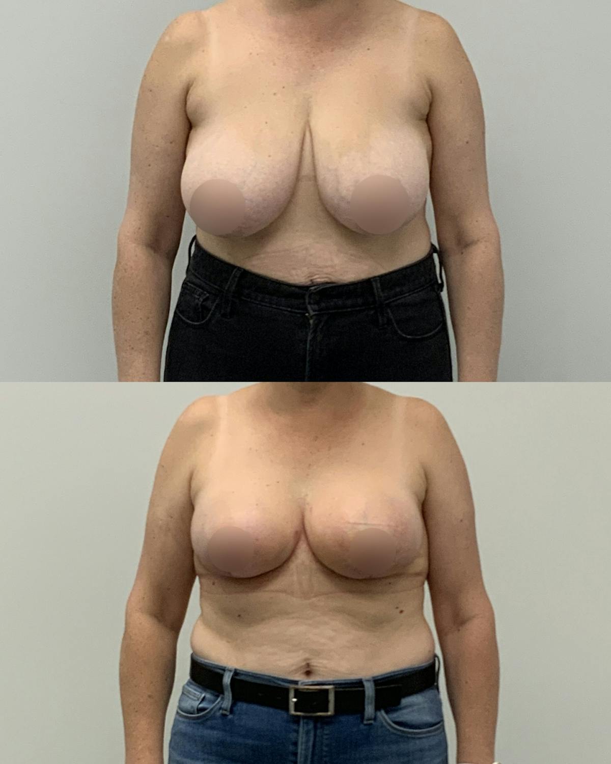 Breast Lift Before & After Gallery - Patient 388774 - Image 1
