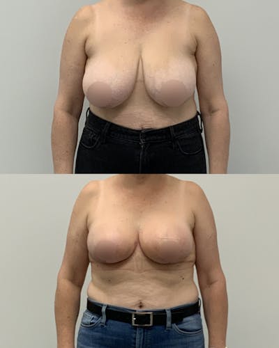 Breast Lift Before & After Gallery - Patient 388774 - Image 1