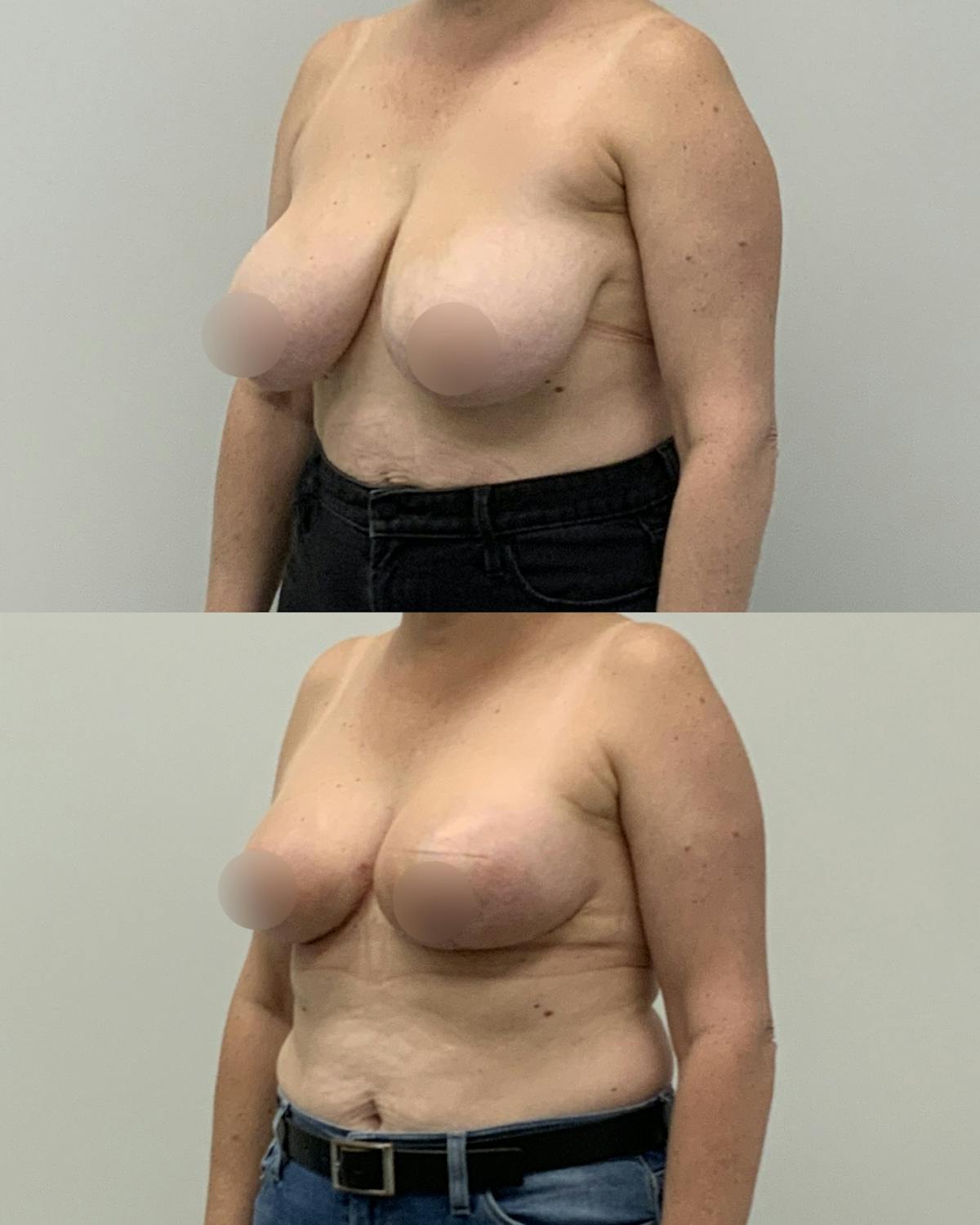 Breast Lift Before & After Gallery - Patient 388774 - Image 2