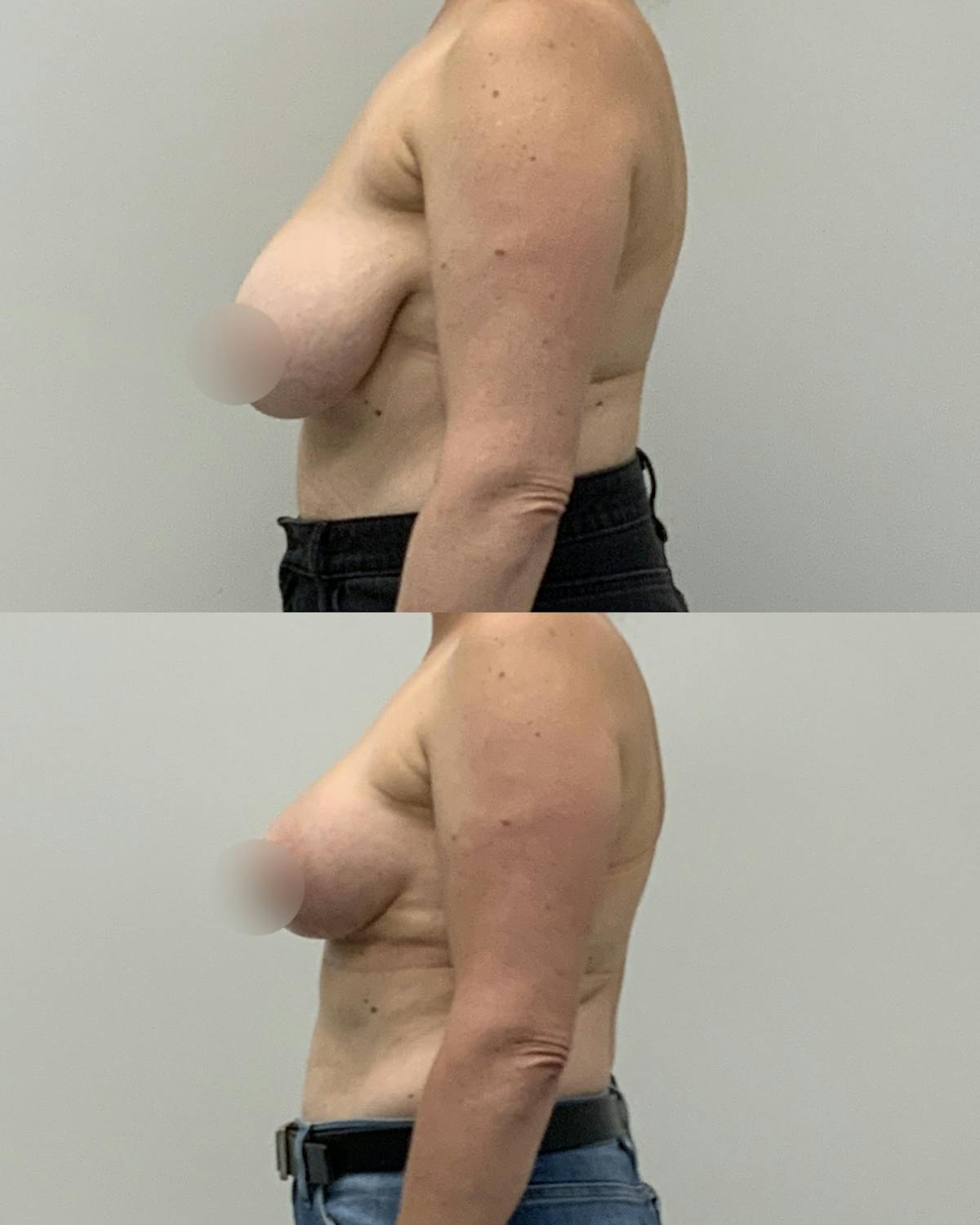 Breast Lift Before & After Gallery - Patient 388774 - Image 3