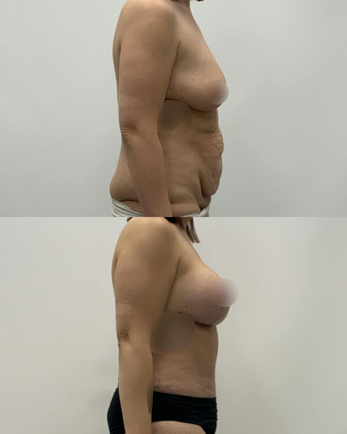Mommy Makeover Before & After Gallery - Patient 117892 - Image 3