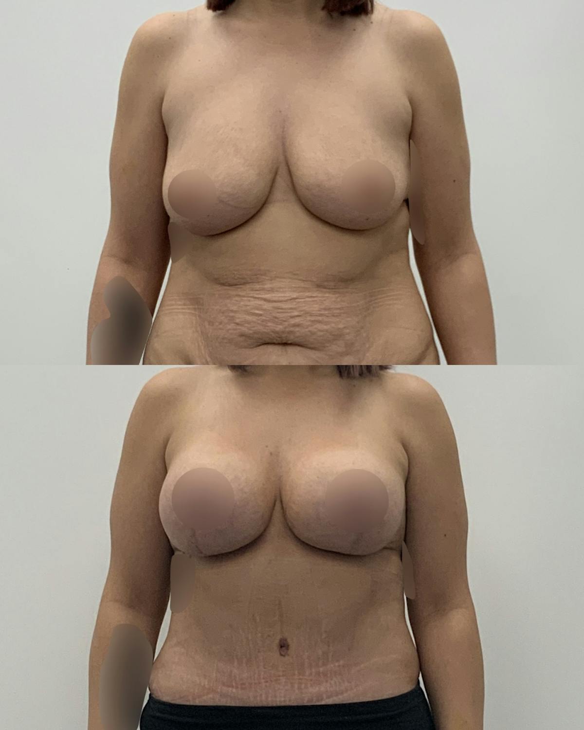 Breast Lift Before & After Gallery - Patient 618661 - Image 1