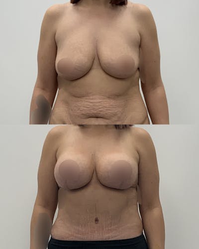 Breast Lift Before & After Gallery - Patient 618661 - Image 1