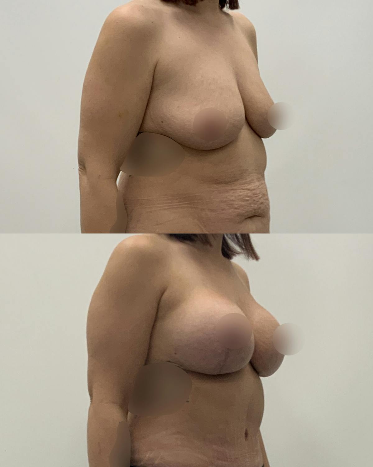 Breast Lift Before & After Gallery - Patient 618661 - Image 2