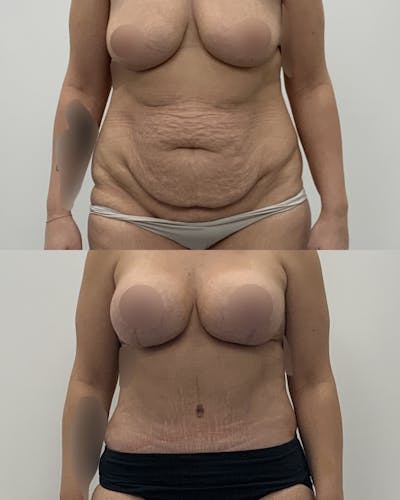 Tummy Tuck Before & After Gallery - Patient 312011 - Image 1