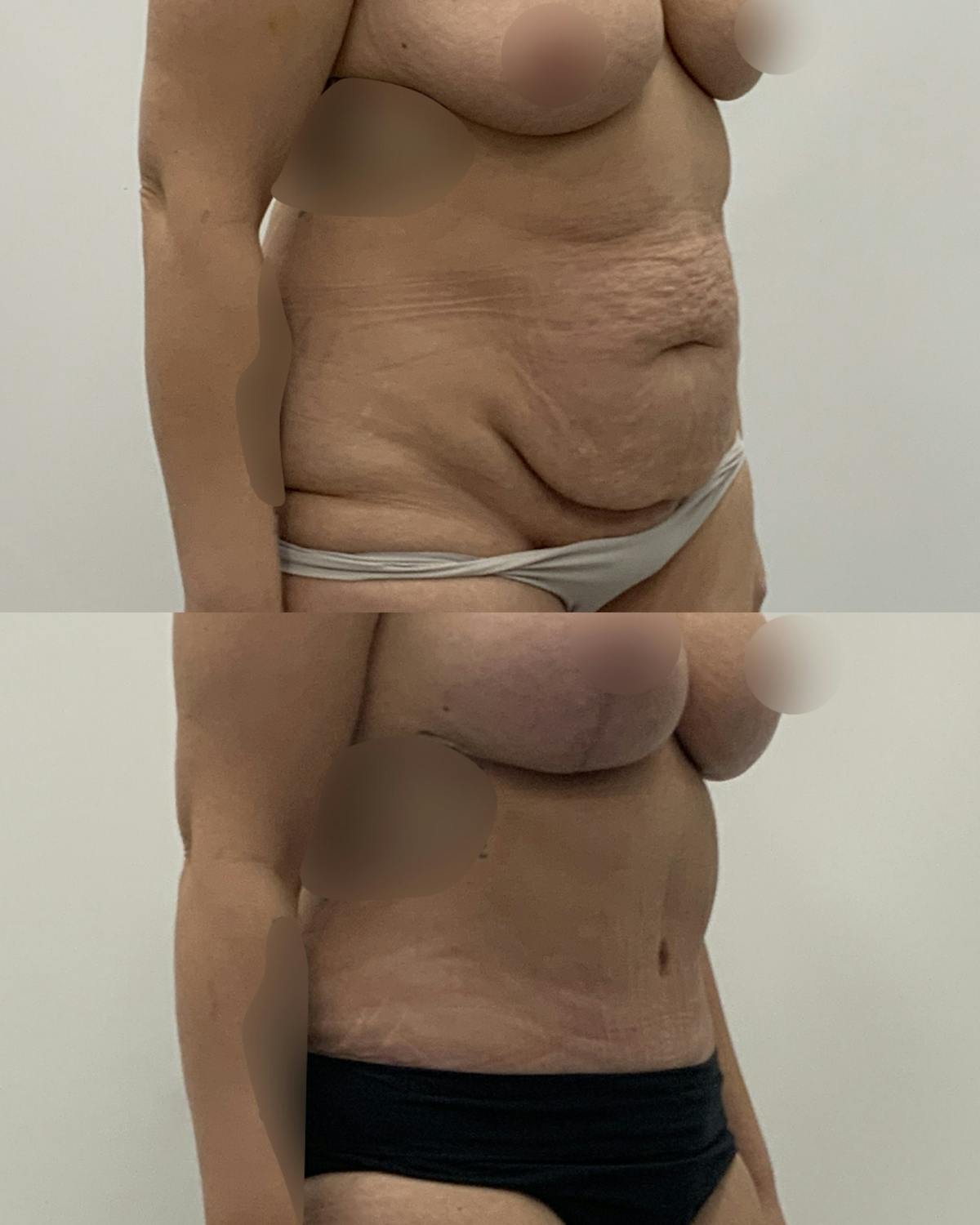 Tummy Tuck Before & After Gallery - Patient 312011 - Image 2