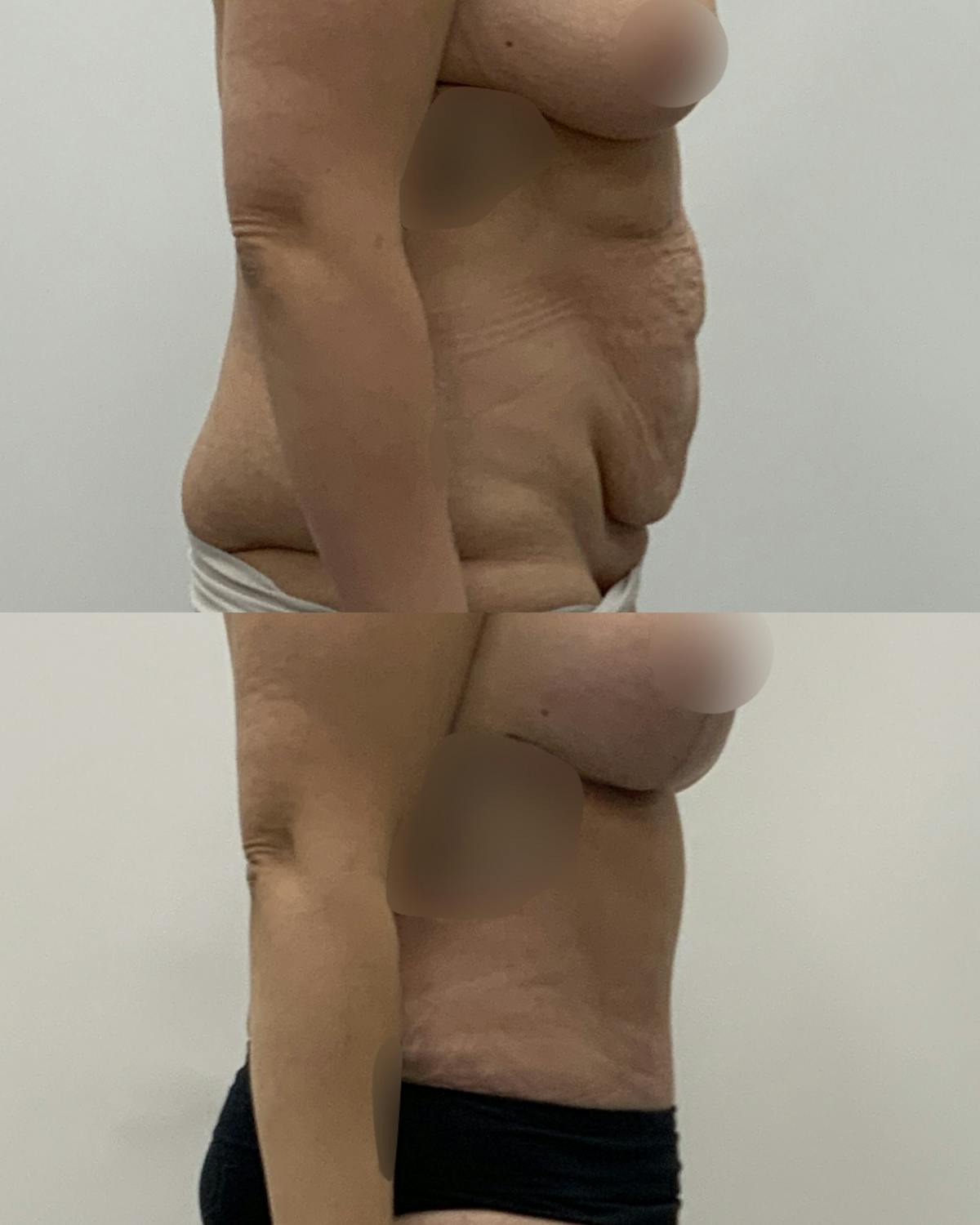 Tummy Tuck Before & After Gallery - Patient 312011 - Image 3