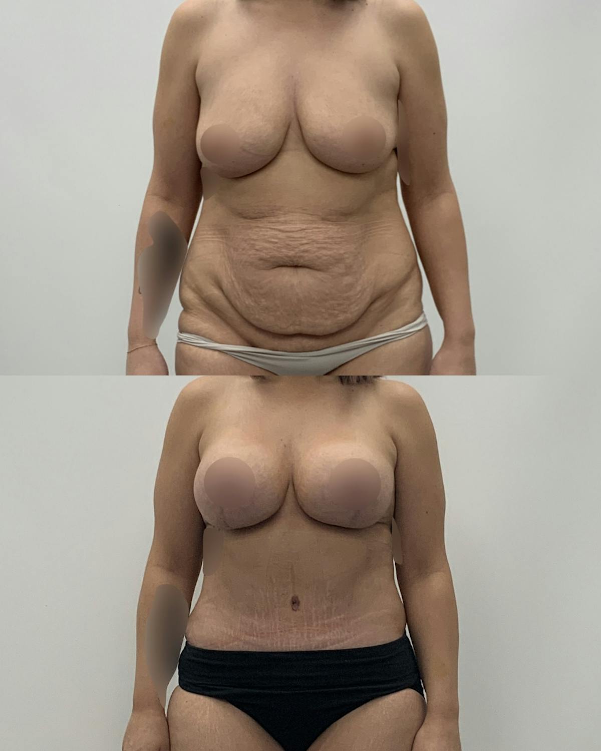 Mommy Makeover Before & After Gallery - Patient 117892 - Image 1