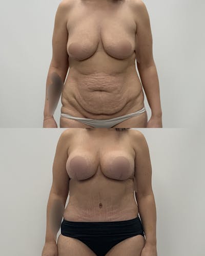 Mommy Makeover Before & After Gallery - Patient 117892 - Image 1