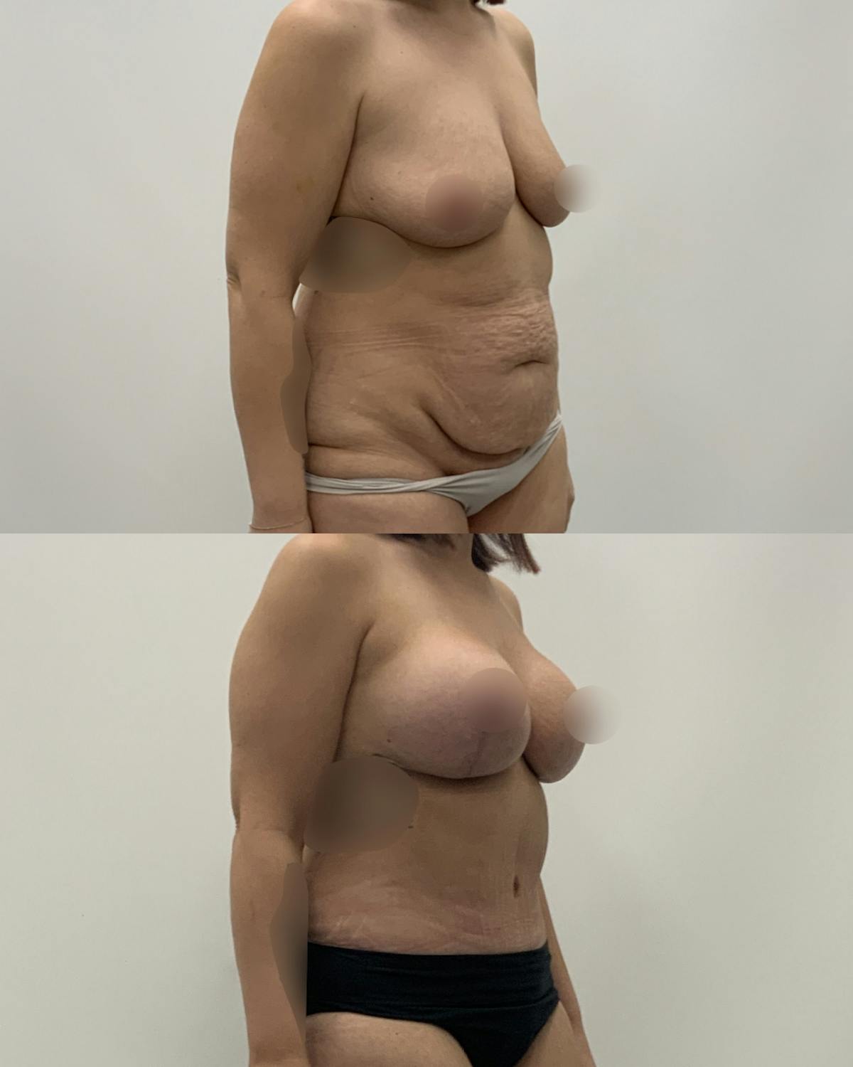 Mommy Makeover Before & After Gallery - Patient 117892 - Image 2