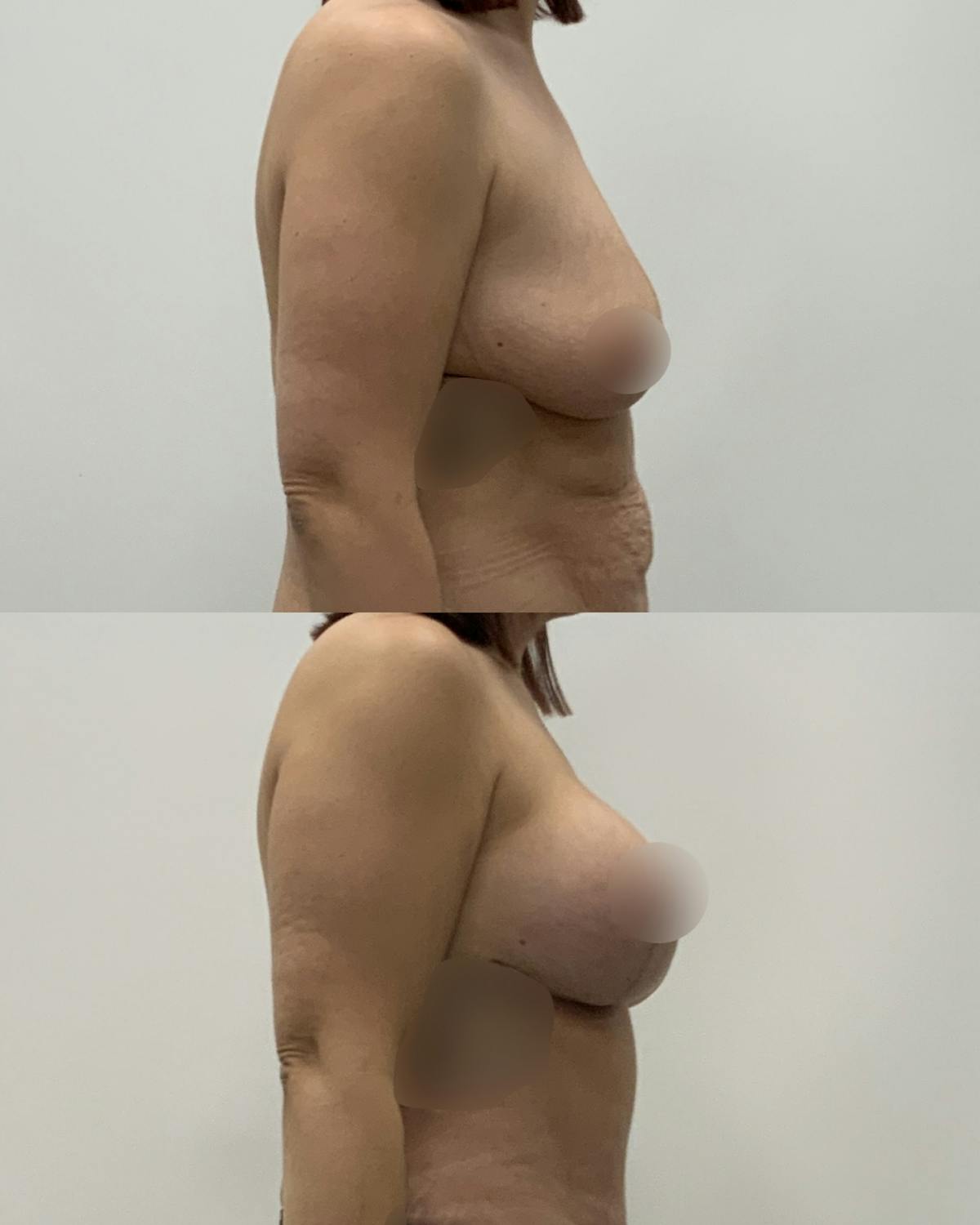 Breast Lift Before & After Gallery - Patient 618661 - Image 3