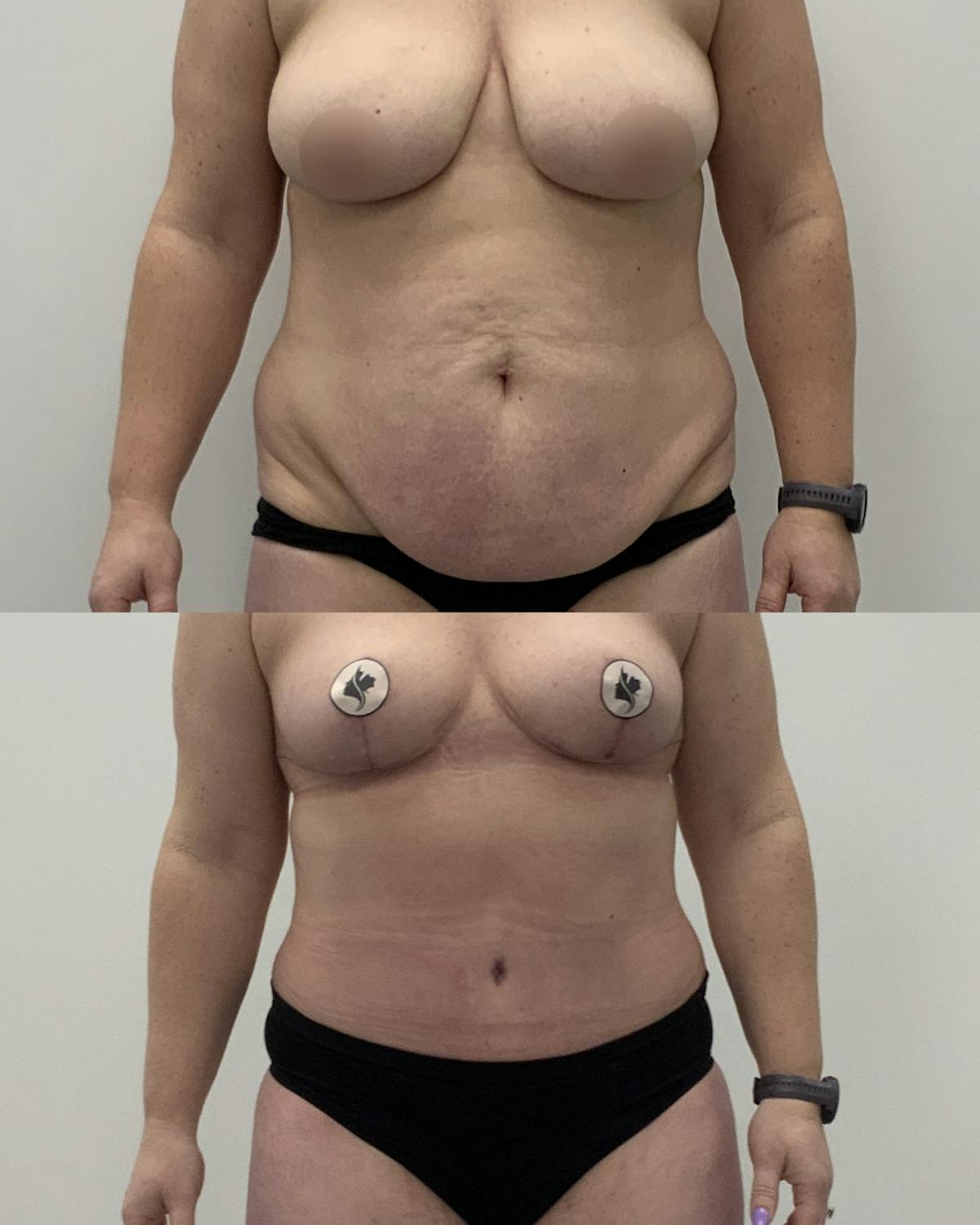 Tummy Tuck Before & After Gallery - Patient 836179 - Image 1