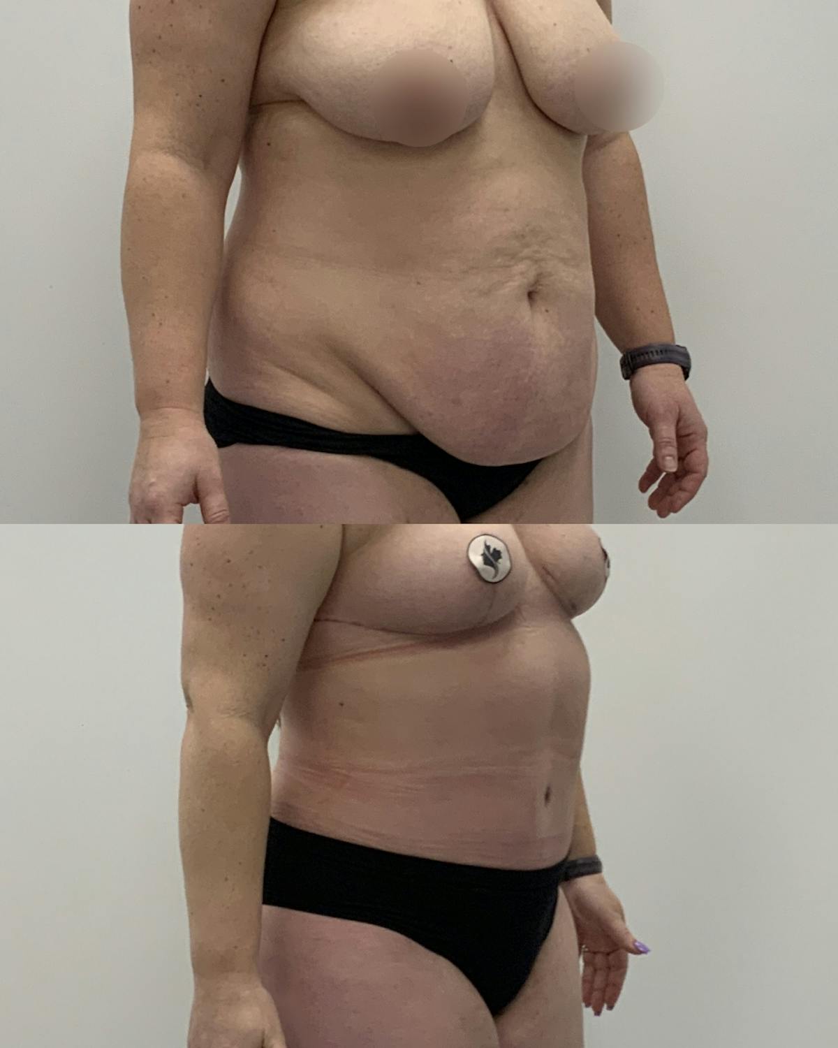 Tummy Tuck Before & After Gallery - Patient 836179 - Image 2