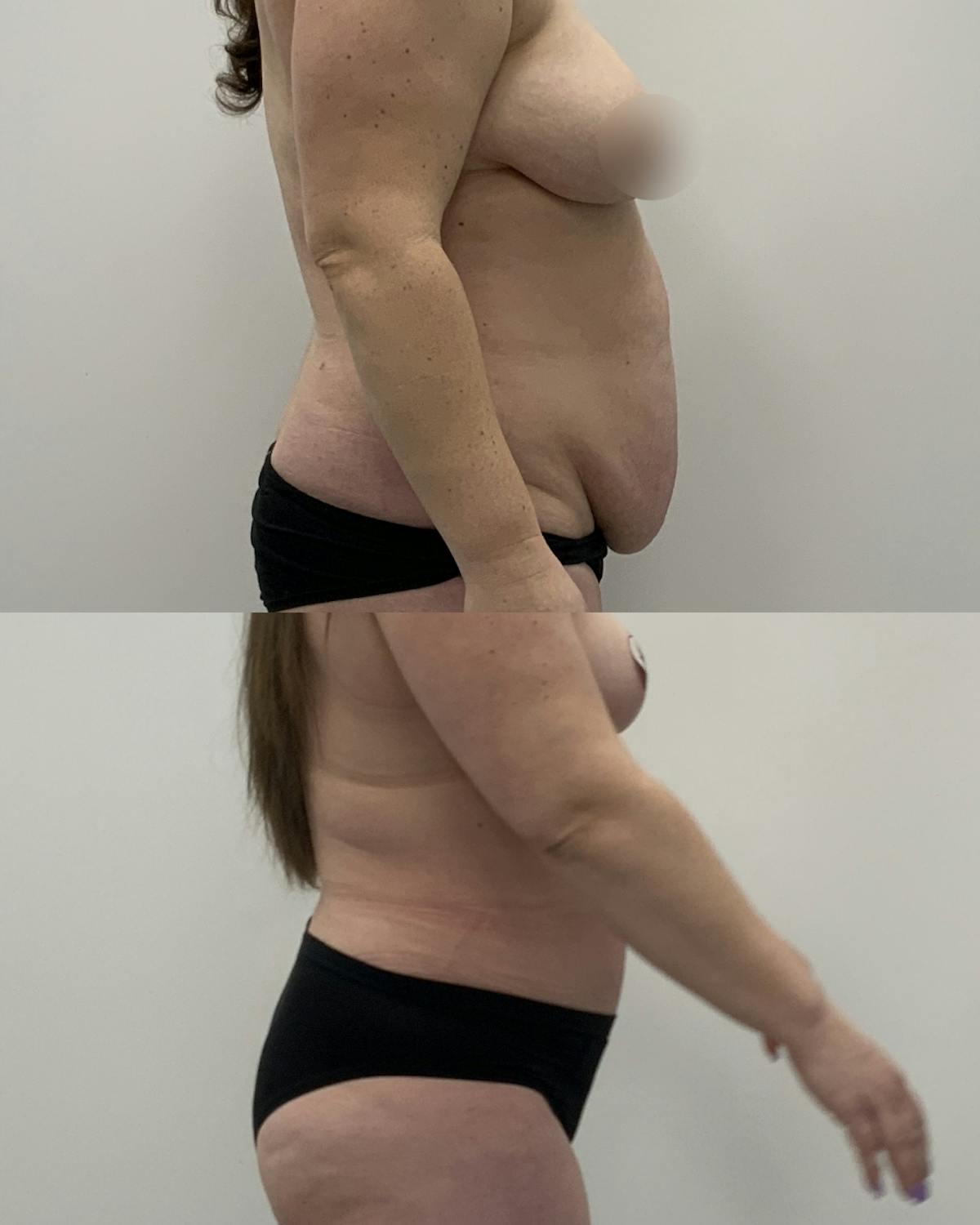 Tummy Tuck Before & After Gallery - Patient 836179 - Image 3