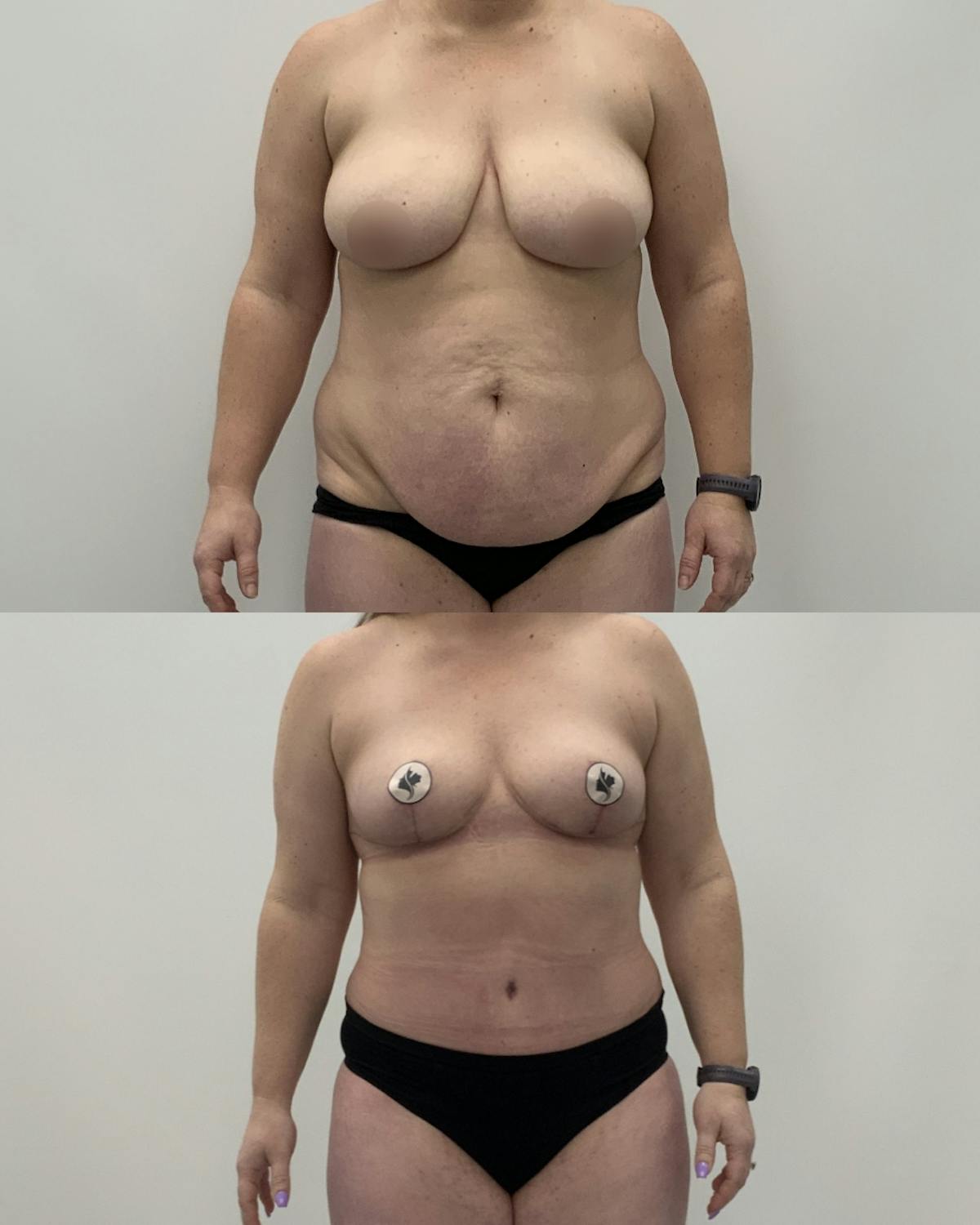 Mommy Makeover Before & After Gallery - Patient 243223 - Image 1