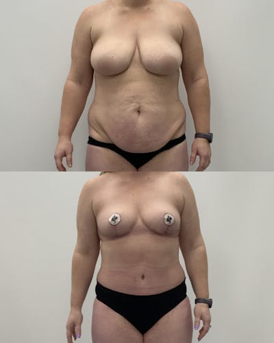 Mommy Makeover Before & After Gallery - Patient 243223 - Image 1