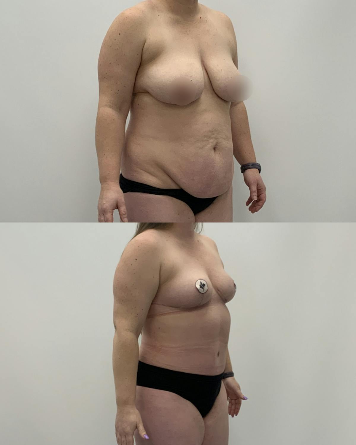 Mommy Makeover Before & After Gallery - Patient 243223 - Image 2