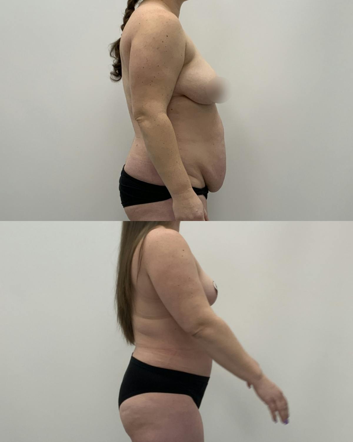 Mommy Makeover Before & After Gallery - Patient 243223 - Image 3