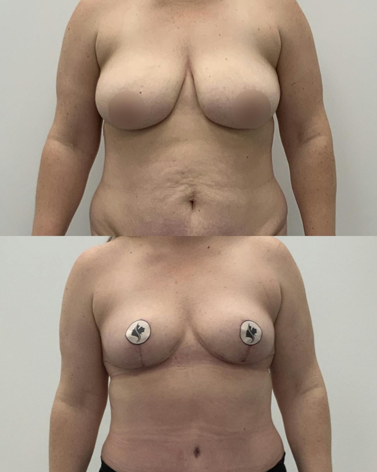 Breast Reduction Before & After Gallery - Patient 238910 - Image 1
