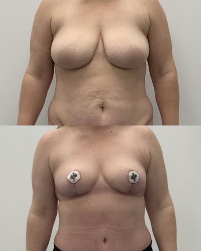 Breast Reduction Before & After Gallery - Patient 238910 - Image 1