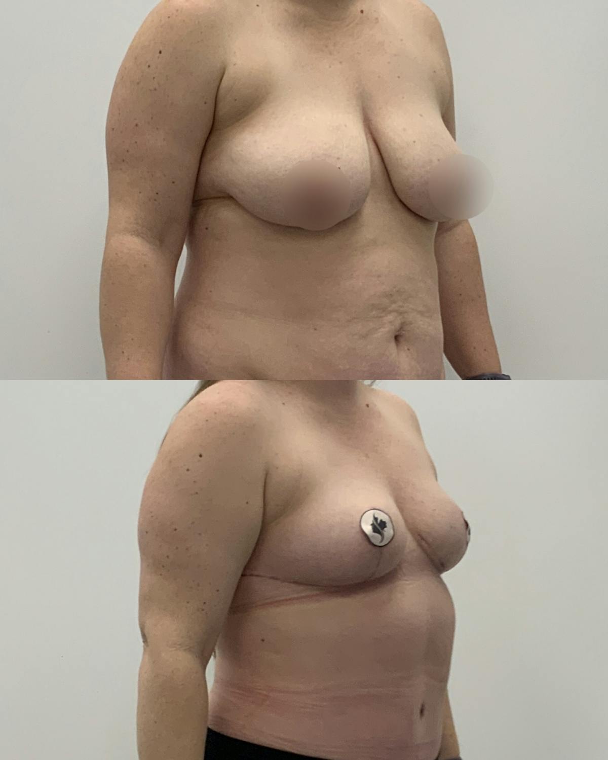 Breast Reduction Before & After Gallery - Patient 238910 - Image 2