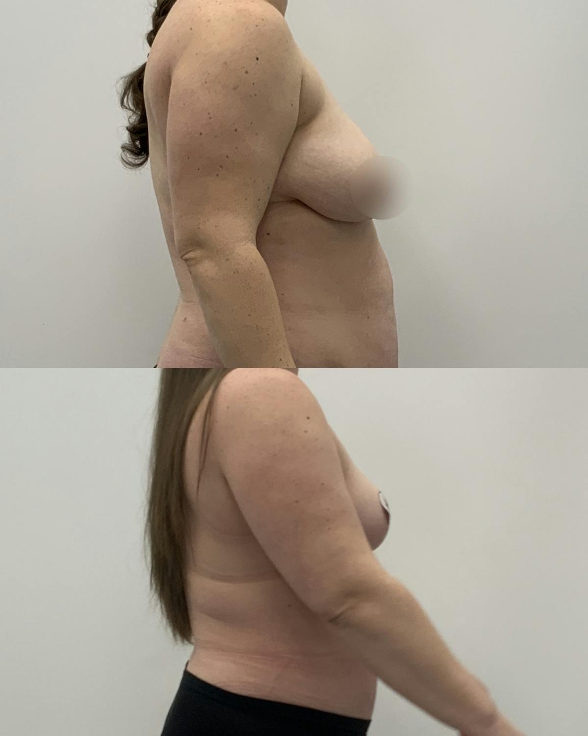 Breast Reduction Before & After Gallery - Patient 238910 - Image 3
