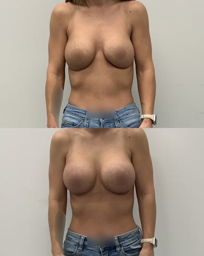 Breast Augmentation Before & After Gallery - Patient 248082 - Image 1