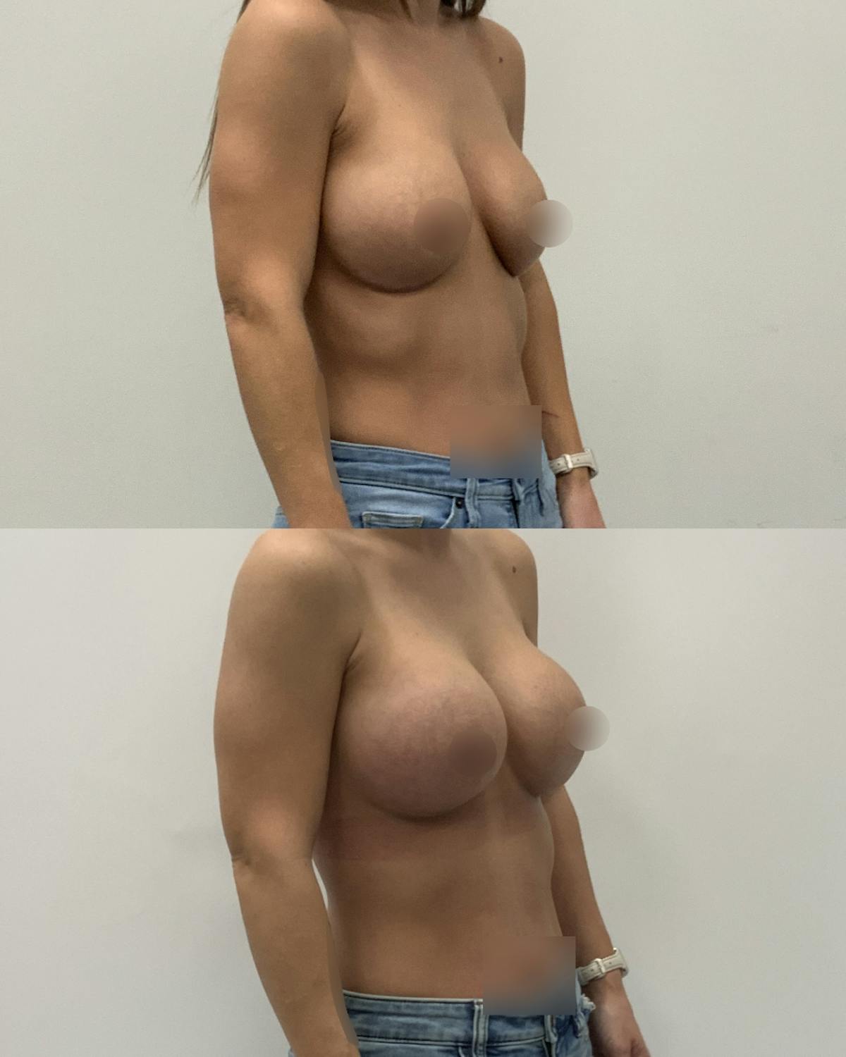 Breast Augmentation Before & After Gallery - Patient 248082 - Image 2