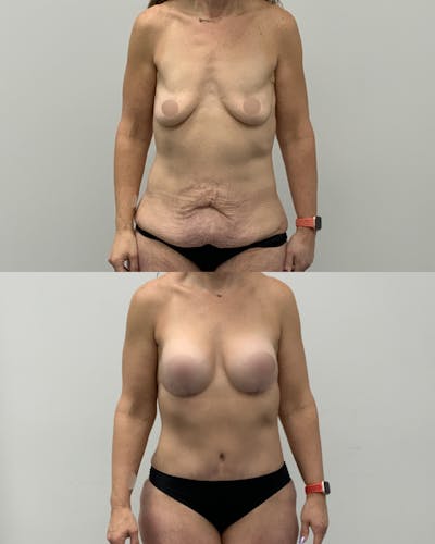 Mommy Makeover Before & After Gallery - Patient 165075 - Image 1