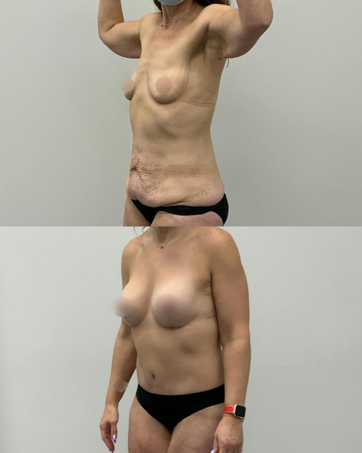 Mommy Makeover Before & After Gallery - Patient 165075 - Image 2