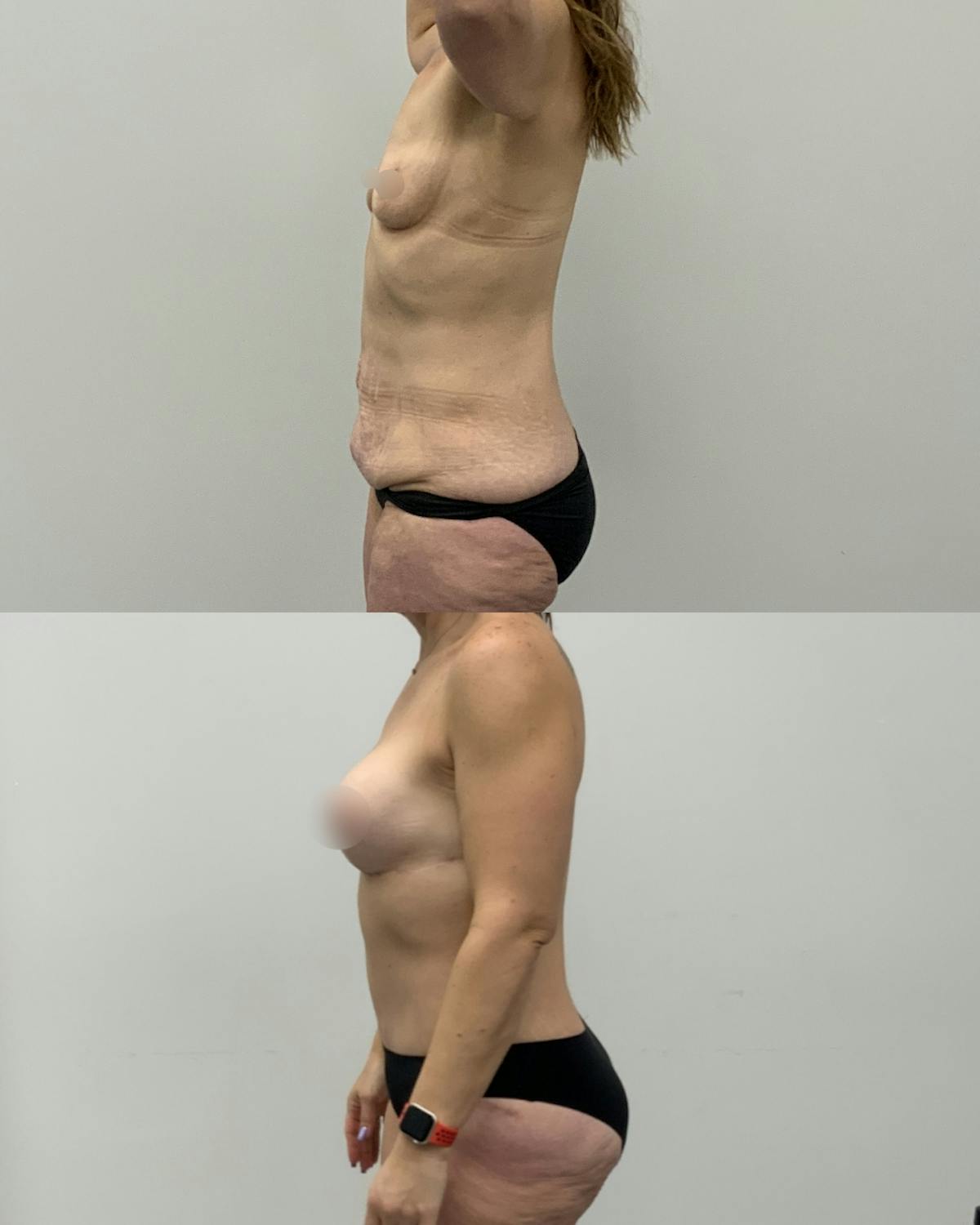 Mommy Makeover Before & After Gallery - Patient 165075 - Image 3