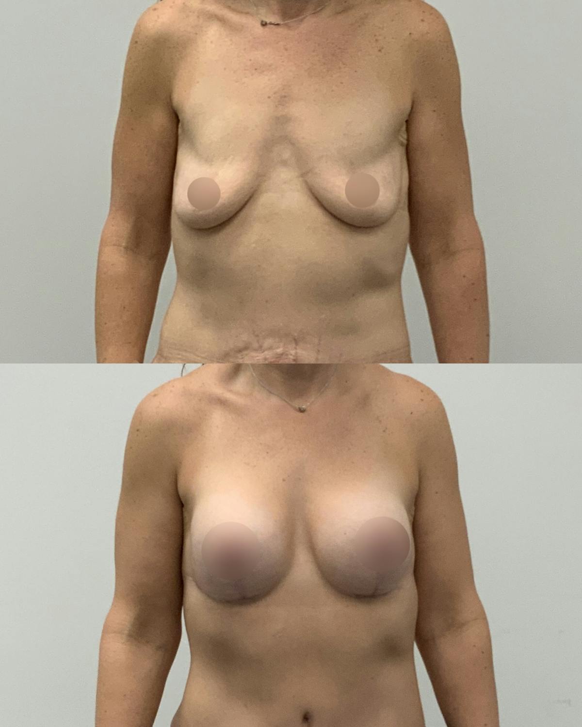 Breast Lift Before & After Gallery - Patient 160021 - Image 1