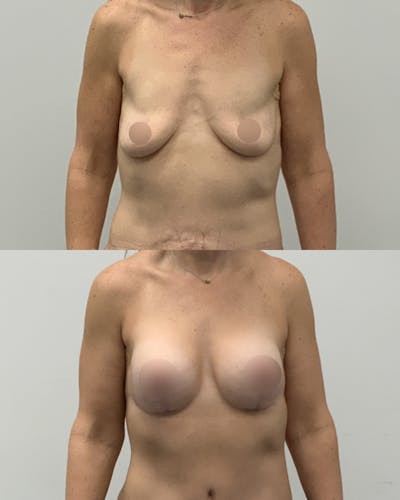 Breast Lift Before & After Gallery - Patient 160021 - Image 1