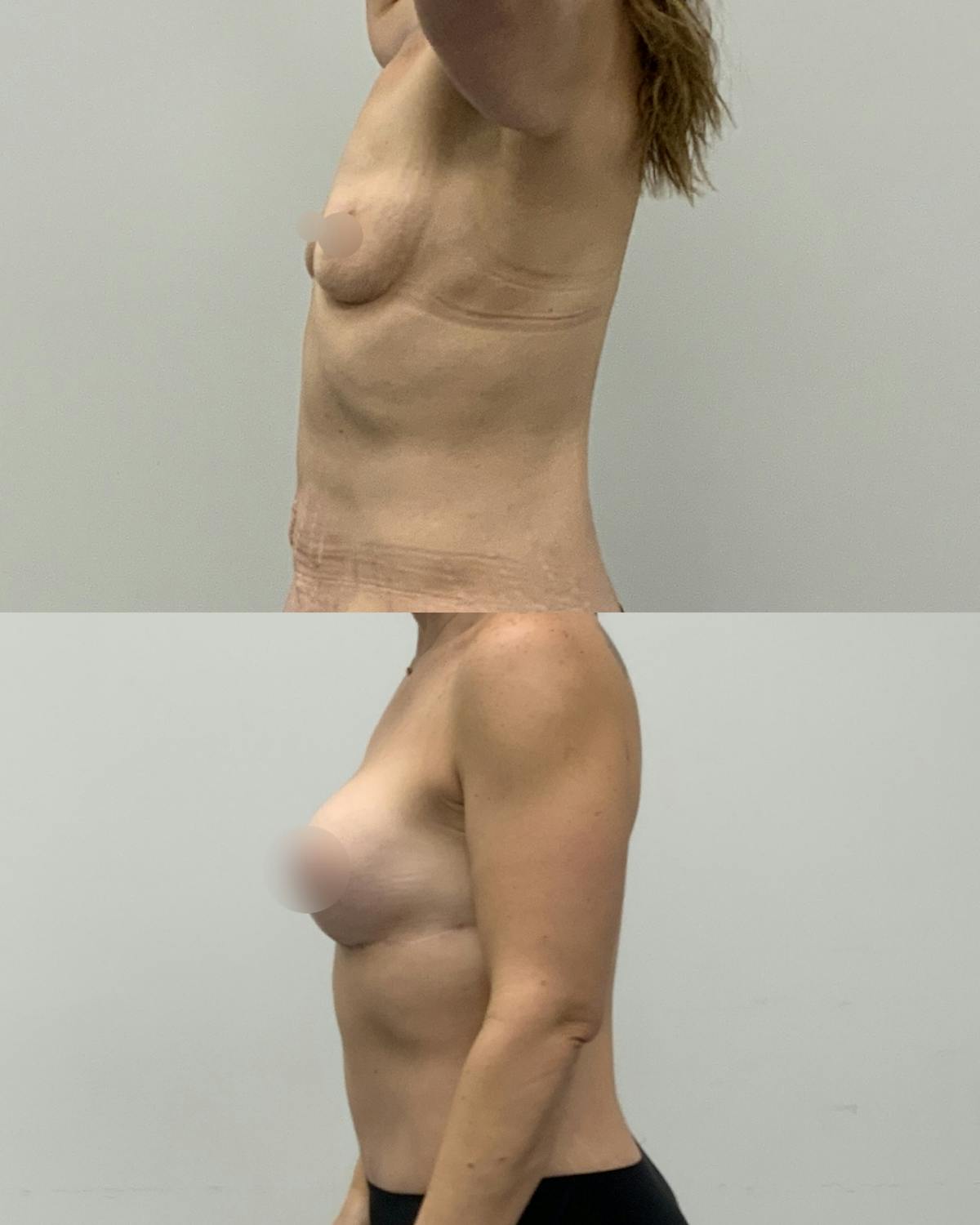 Breast Lift Before & After Gallery - Patient 160021 - Image 3