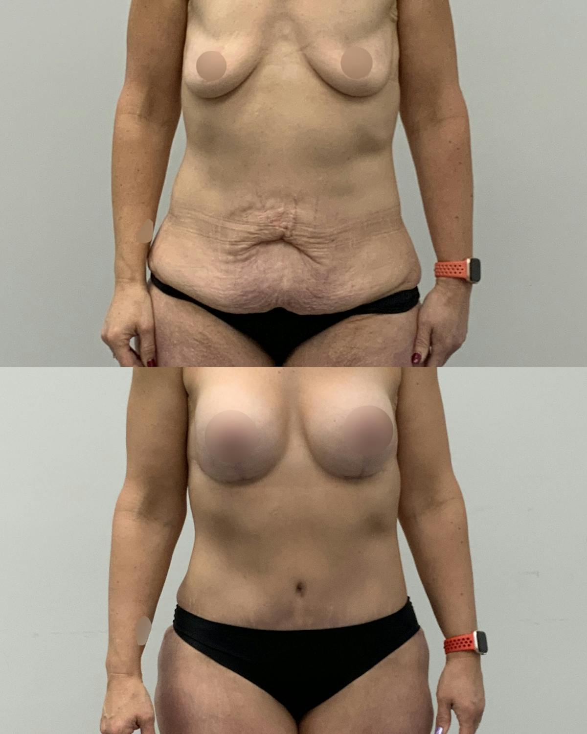 Tummy Tuck Before & After Gallery - Patient 403240 - Image 1